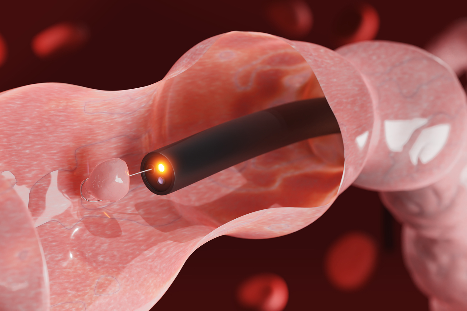 3D illustration of a blood vessel with a catheter laser treating an obstruction.