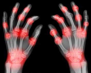 X-ray of hands with red inflammation, showing joint pain likely caused by arthritis or rheumatoid disease.