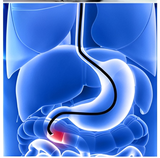 Illustration of human digestive system with focus on intestine, highlighting a red area indicating an issue.