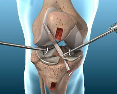 Illustration of a knee surgery showing instruments inside an opened knee joint.