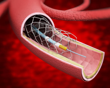 a close up of a blood vessel with a needle in it