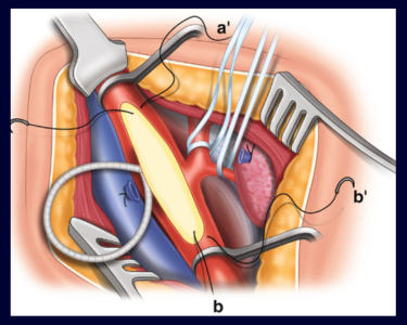 Illustration of a surgical knee operation with instruments and exposed anatomy.