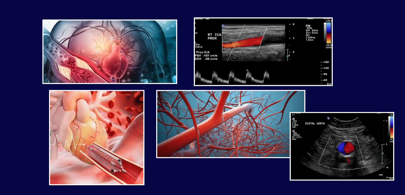 Collage of vascular system illustrations and ultrasound images displaying blood flow and potential blockages.